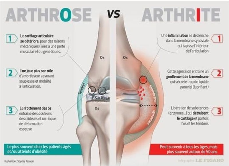 arthrose vs arthrite.jpg